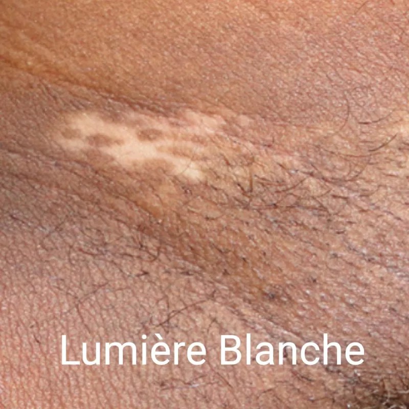 LAMPE DE WOOD AVEC LOUPE