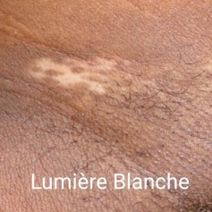 LAMPE DE WOOD AVEC LOUPE