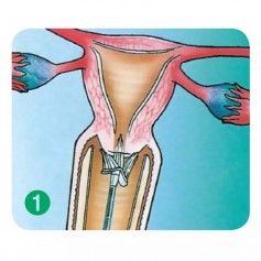 Balai endocervical - Boîte de 50