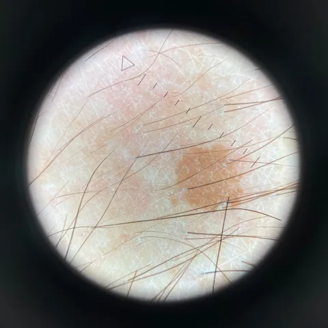 Dermatoscope HEINE DELTA one + Adaptateur universel smartphone offert