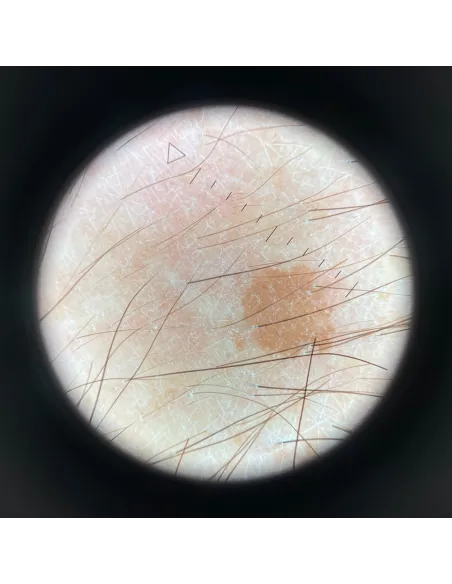 Dermatoscope HEINE DELTA one + Adaptateur universel smartphone offert