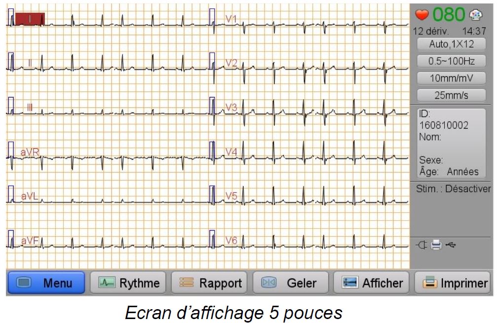 Ecran de l'electrocardiographe