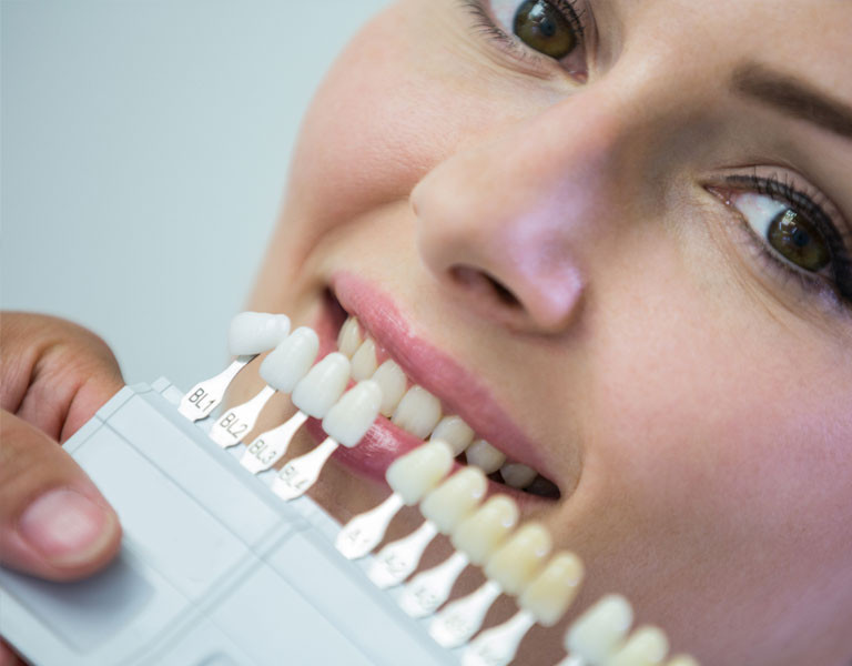 Qu’est-ce qu’une facette dentaire : avantages, pose, contraintes… tout savoir