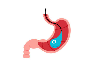 Zoom sur la chirurgie de l'obésité morbide